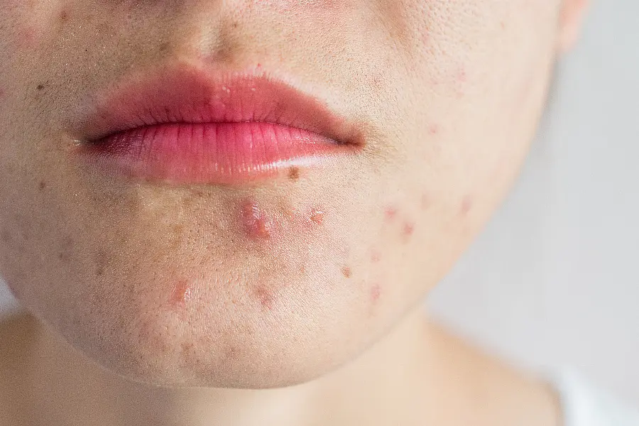 Close-up of woman half face with problems of acne inflammation (Papule and Pustule) on her face.