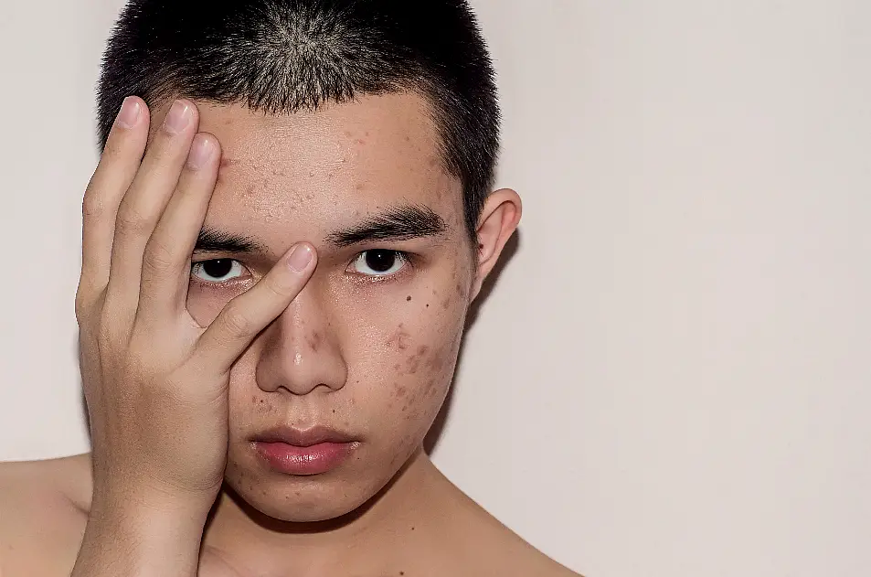 Young man with acne