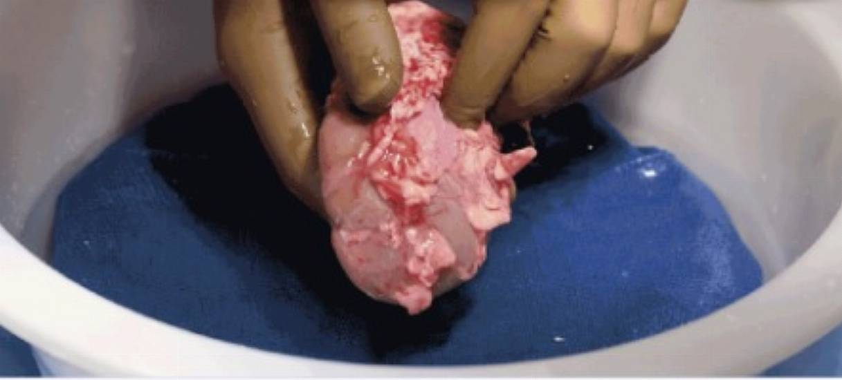 Pig Kidney Successfully Transplanted Into A Human For The First Time