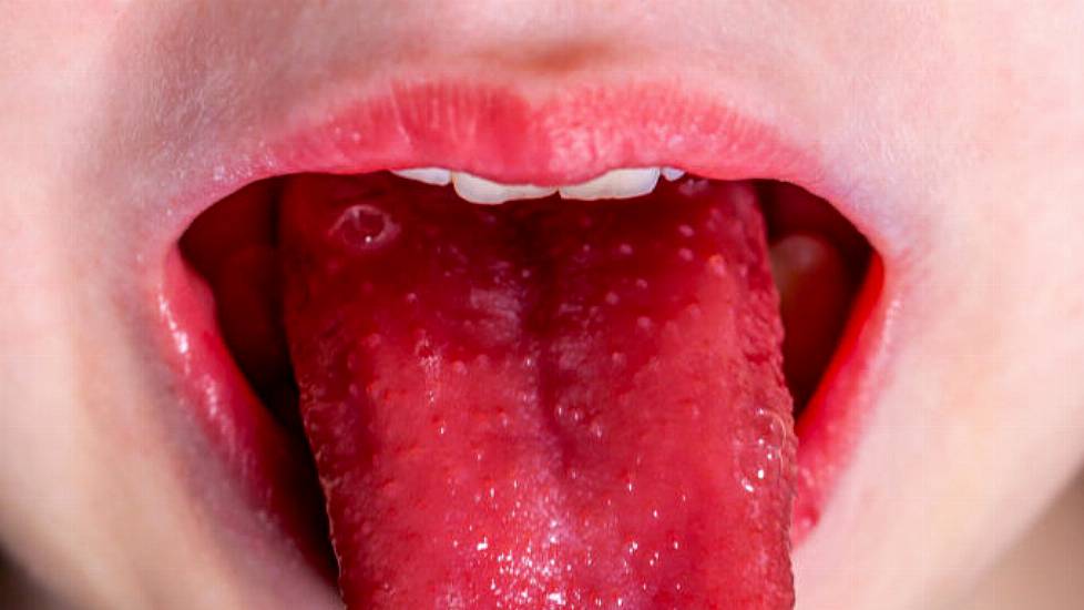 Parents Warned To Look Out For Strep A Symptoms Due To Weakened Immune Systems