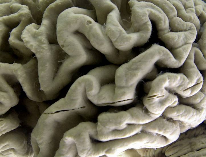 Us Approves Alzheimer’s Drug That Can Slow Disease’s Progress