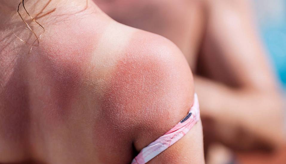 6 Sunburn Myths That Could Put You At Risk