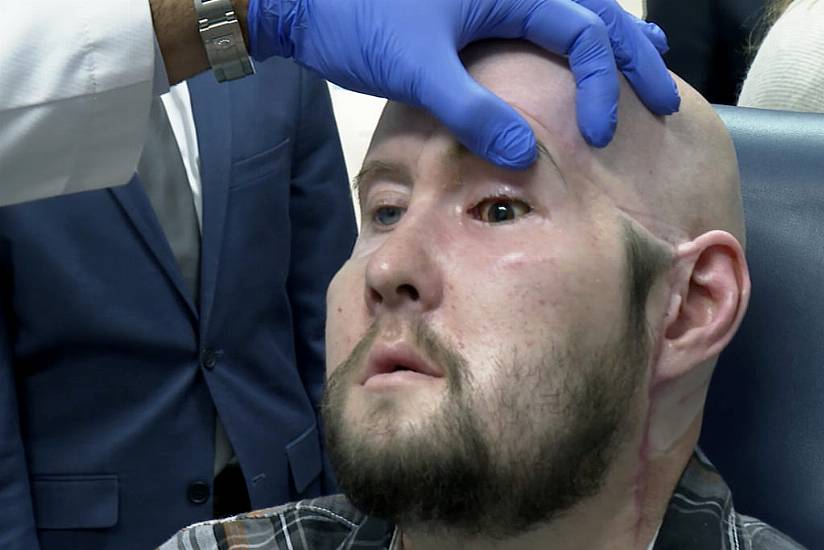 Surgeons Perform World’s First Eye Transplant On Man Who Suffered Electric Shock