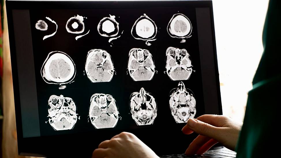 Longer Term Impact Of Sport-Related Brain Injuries Revealed By Study